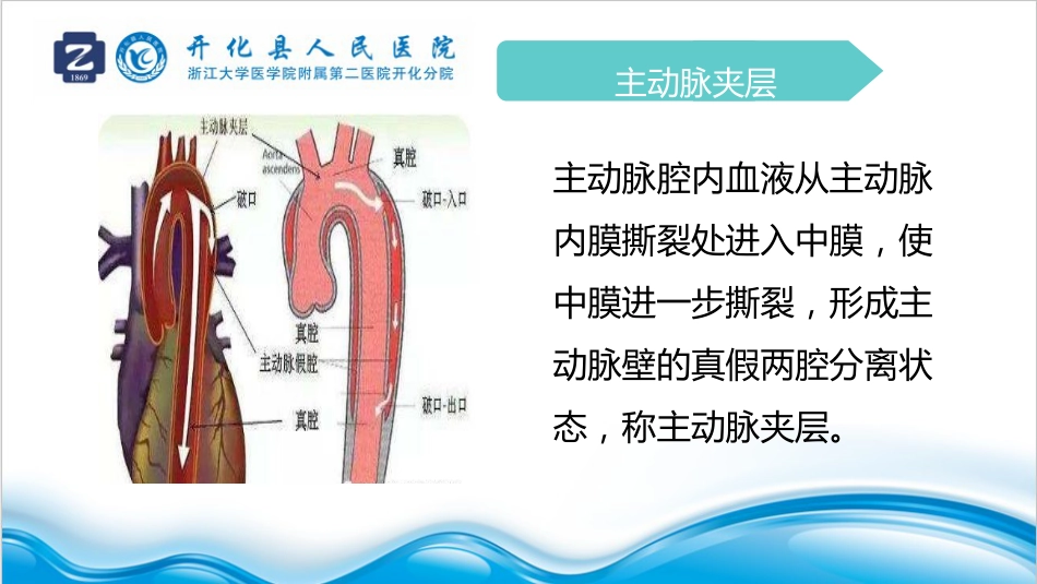 主动脉夹层业务学习报告_第3页