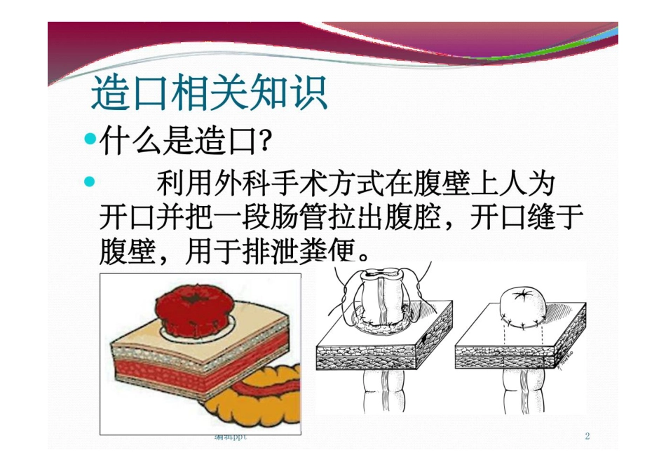 造口护理查房_第2页