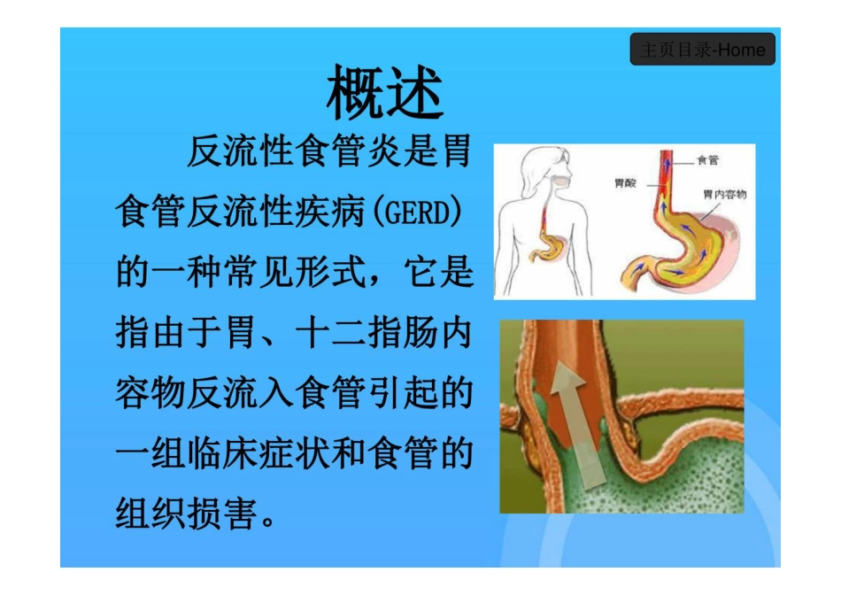 反流性食管炎PPT_第3页