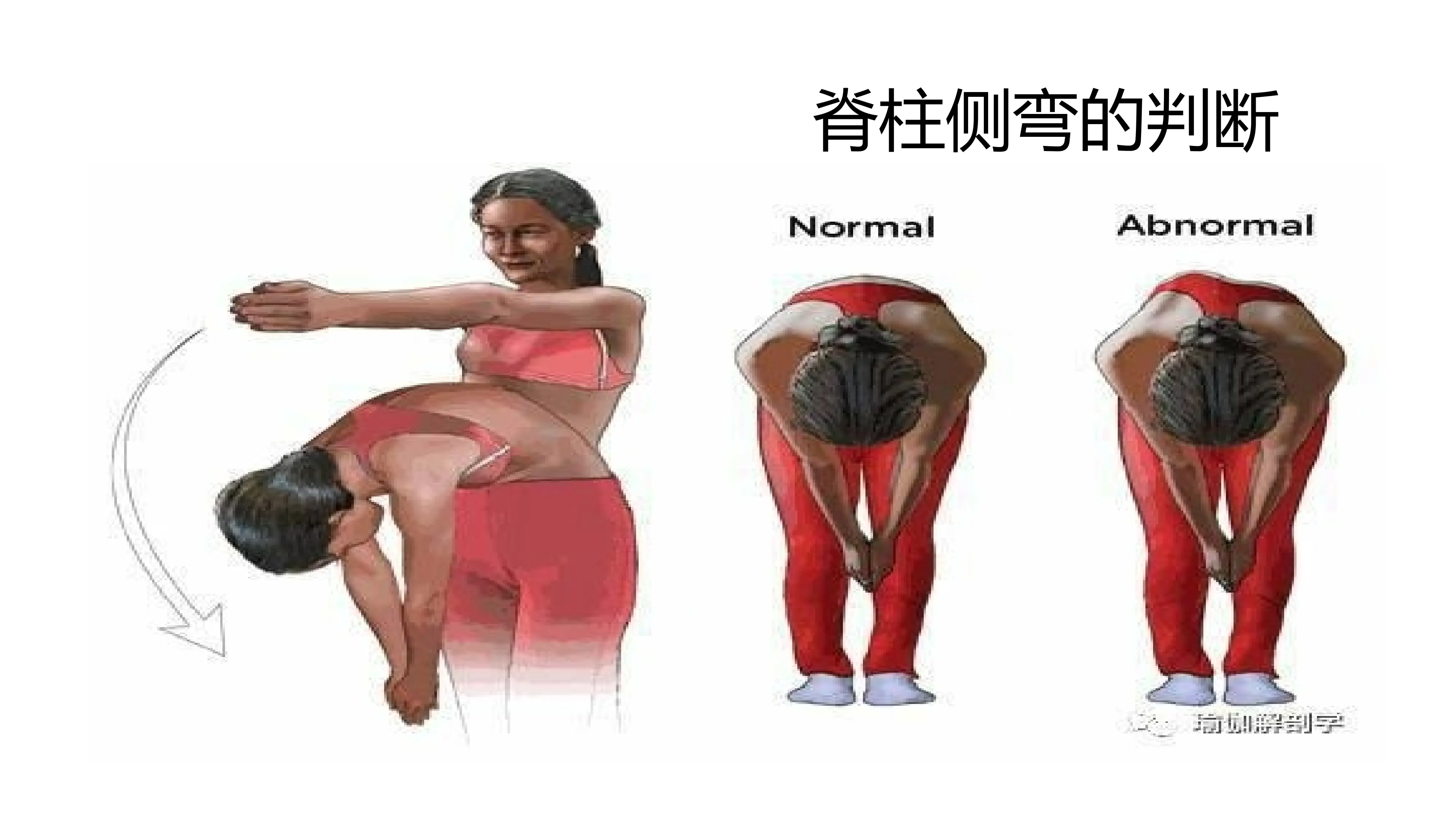 脊柱侧弯PTT_第2页