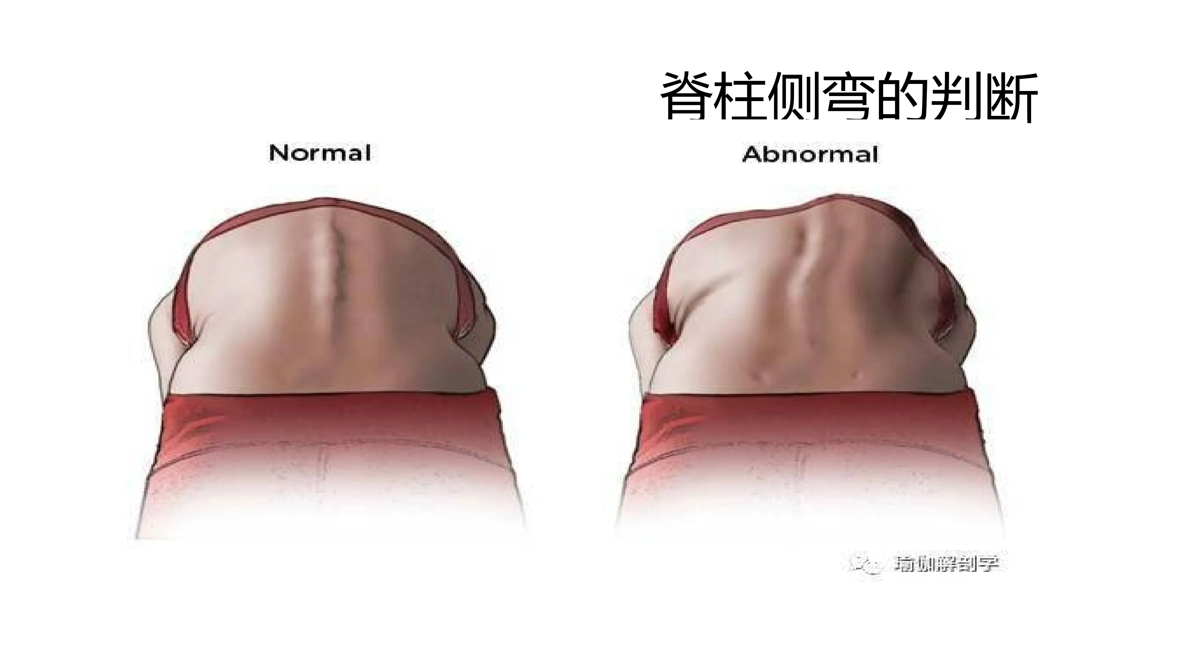 脊柱侧弯PTT_第3页