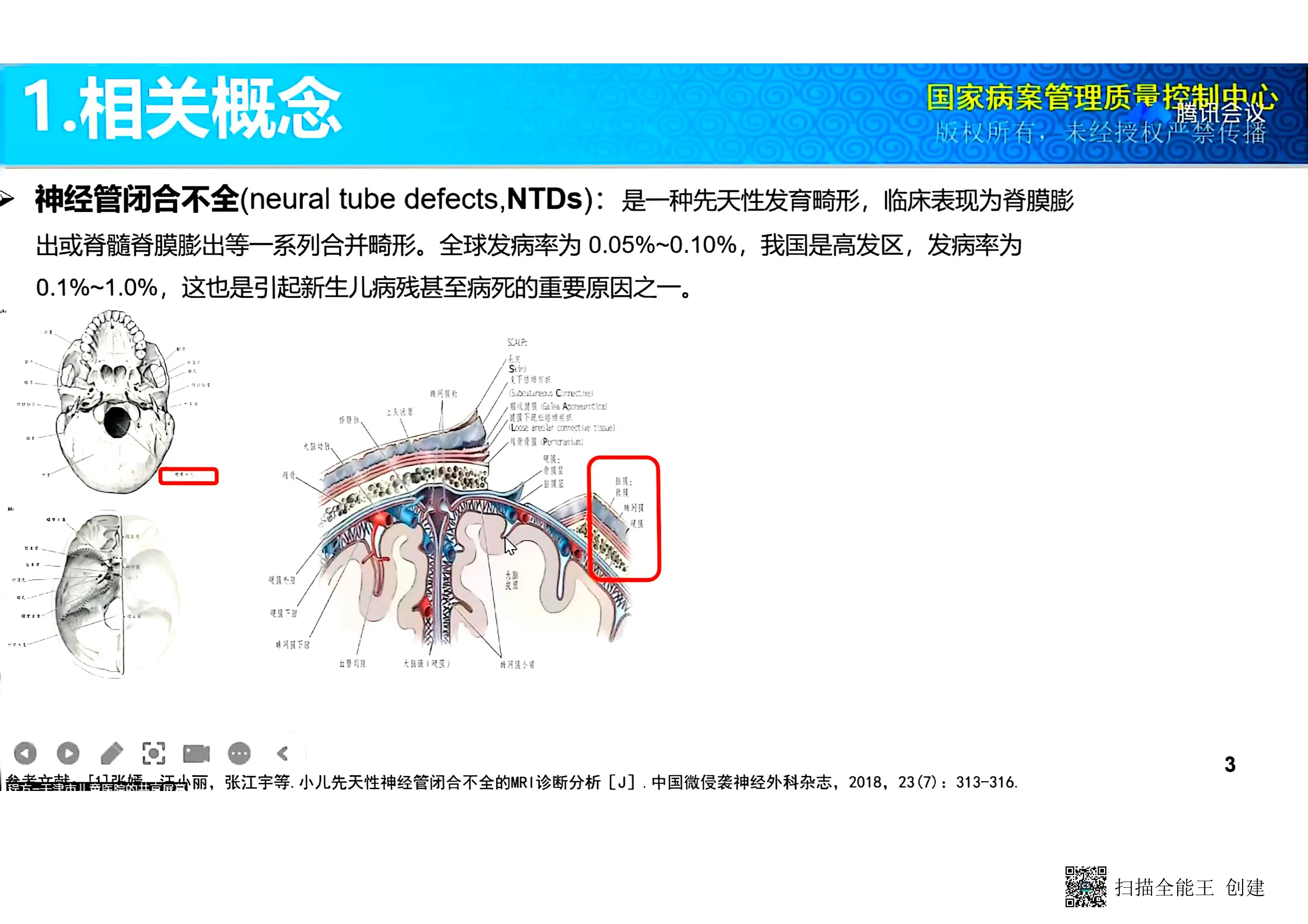 神经管闭合不全常见疾病及手术编码.pdf_第1页