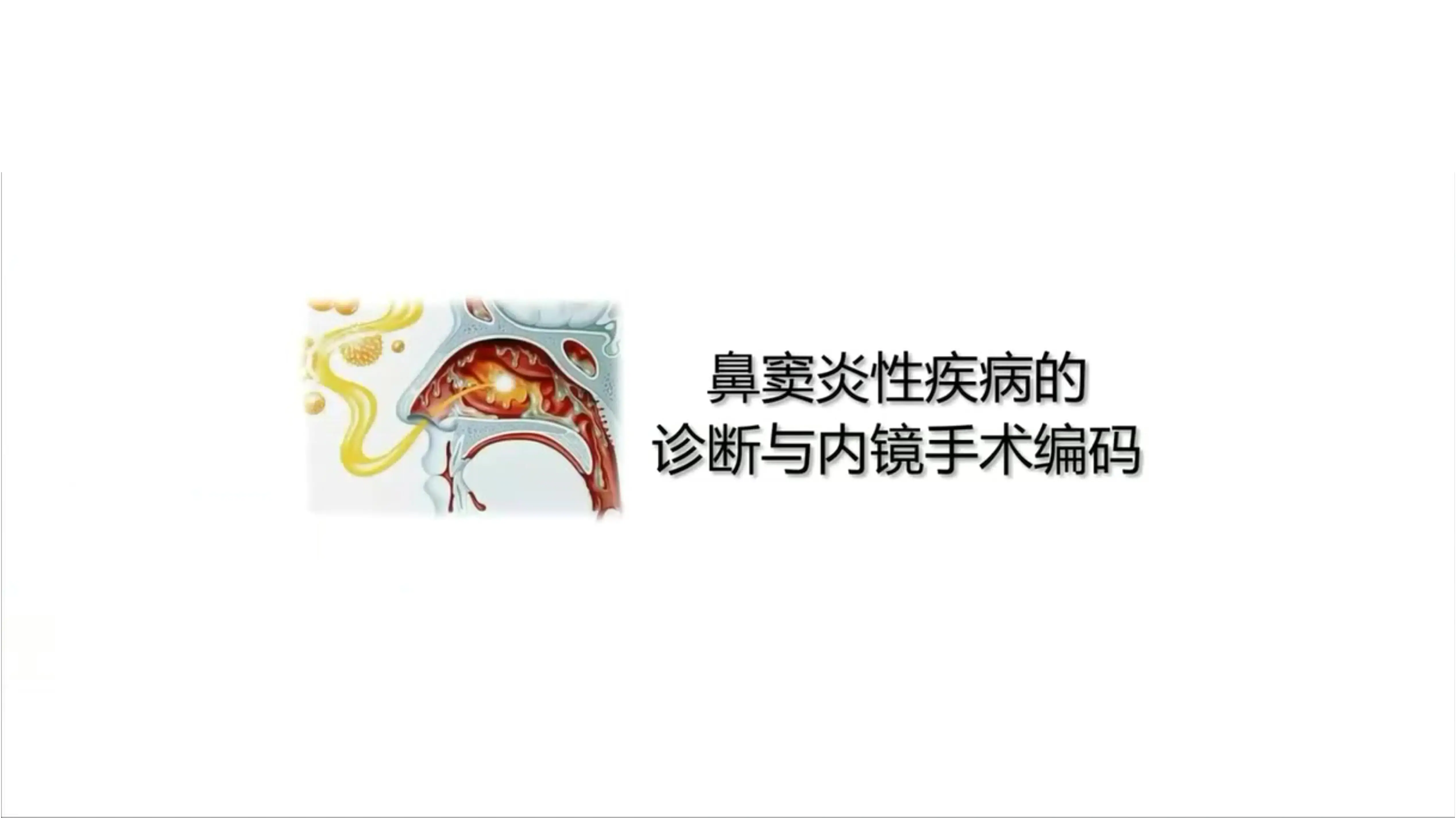 鼻窦炎性疾病的诊断与内镜手术编码.pdf_第1页