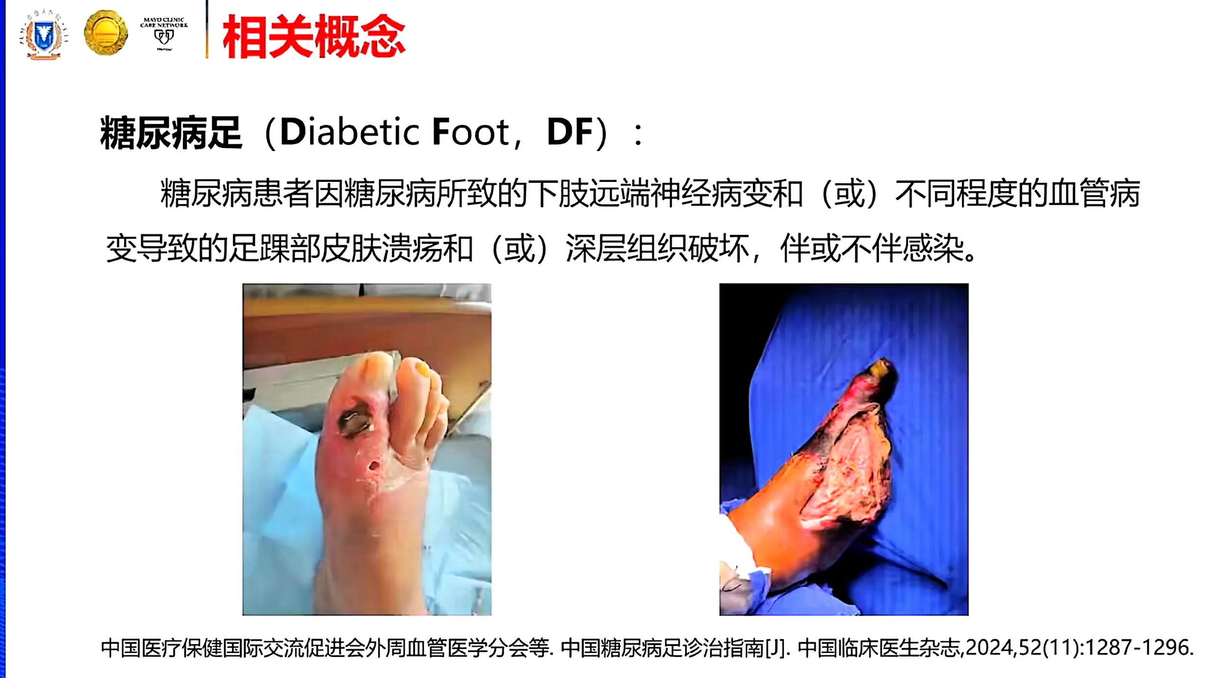 糖尿病足的诊断和手术编码.pdf_第3页
