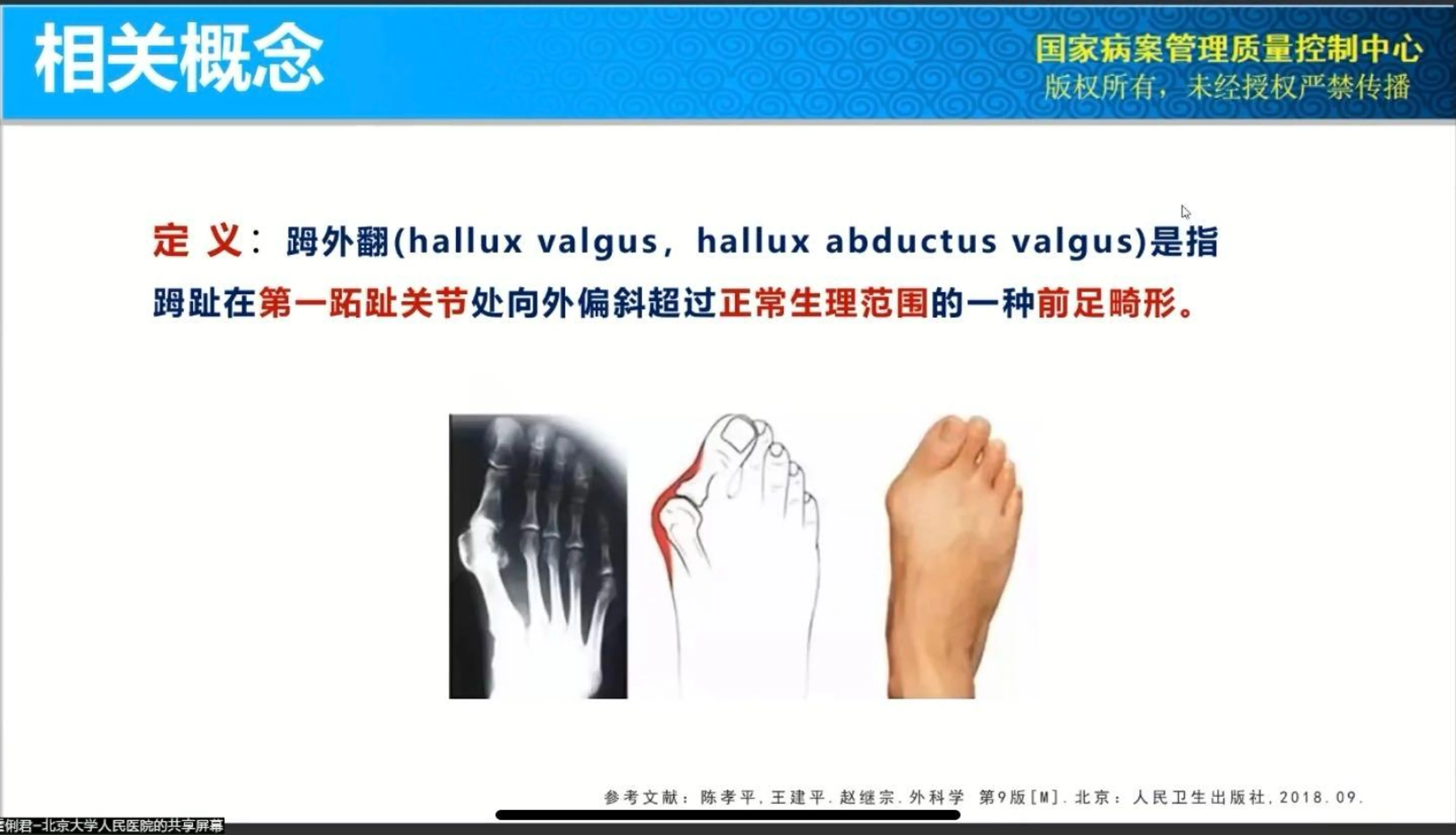 踇外翻编码分析案例.pdf_第1页